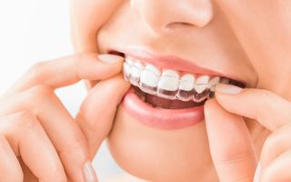 Retainers is great option to straighten your teeth.