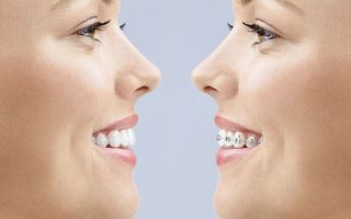 Comparing Invisalign vs braces